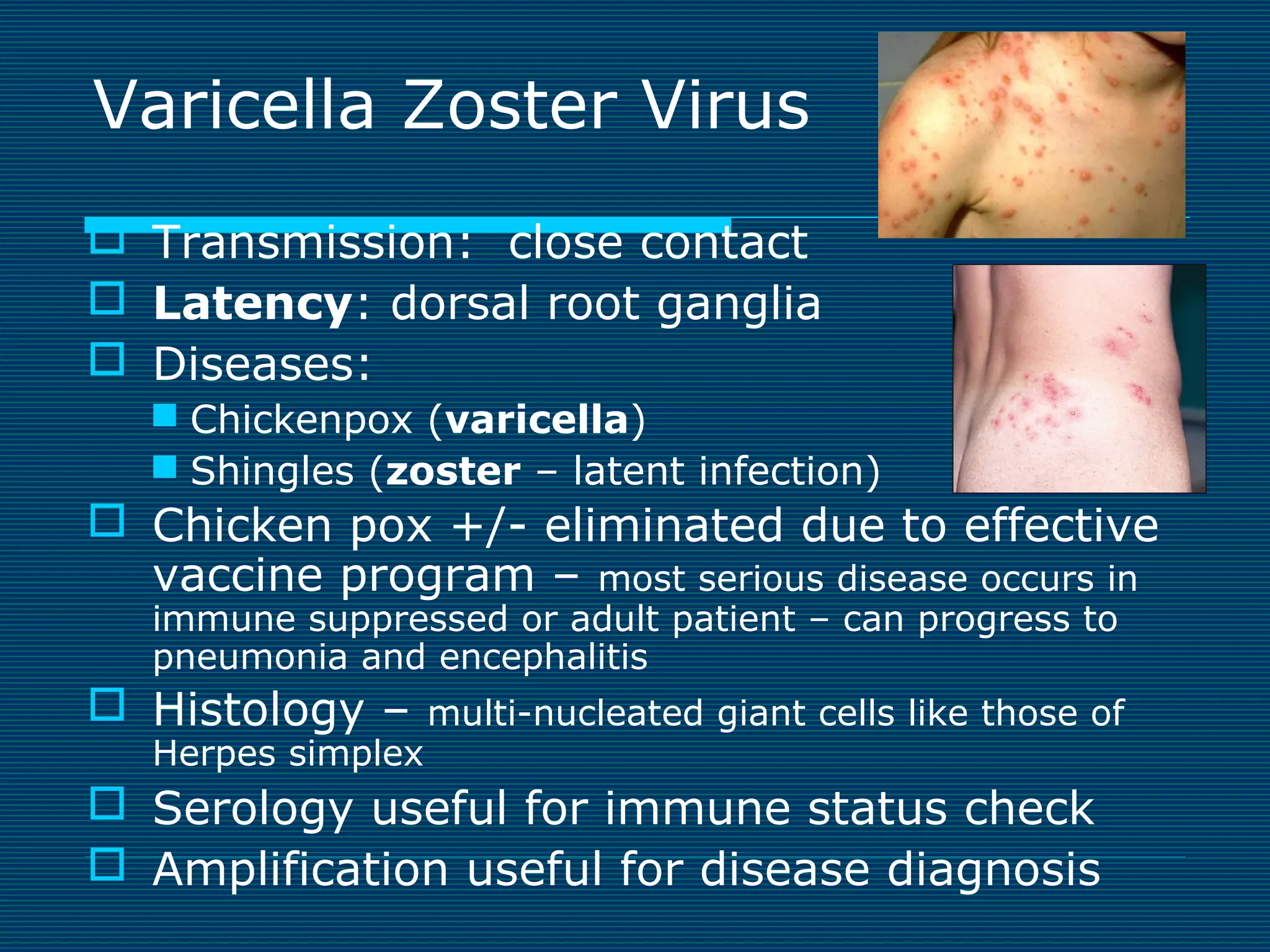 Varicella Zoster Virus
 Transmission: close contact
 Latency: dorsal root ganglia
 Diseases:
 Chickenpox (varicella)
 Shingles (zoster – latent infection)

 Chicken pox +/- eliminated due to effective
vaccine program – most serious disease occurs in
immune suppressed or adult patient – can progress to
pneumonia and encephalitis

 Histology –

Herpes simplex

multi-nucleated giant cells like those of

 Serology useful for immune status check
 Amplification useful for disease diagnosis

 
