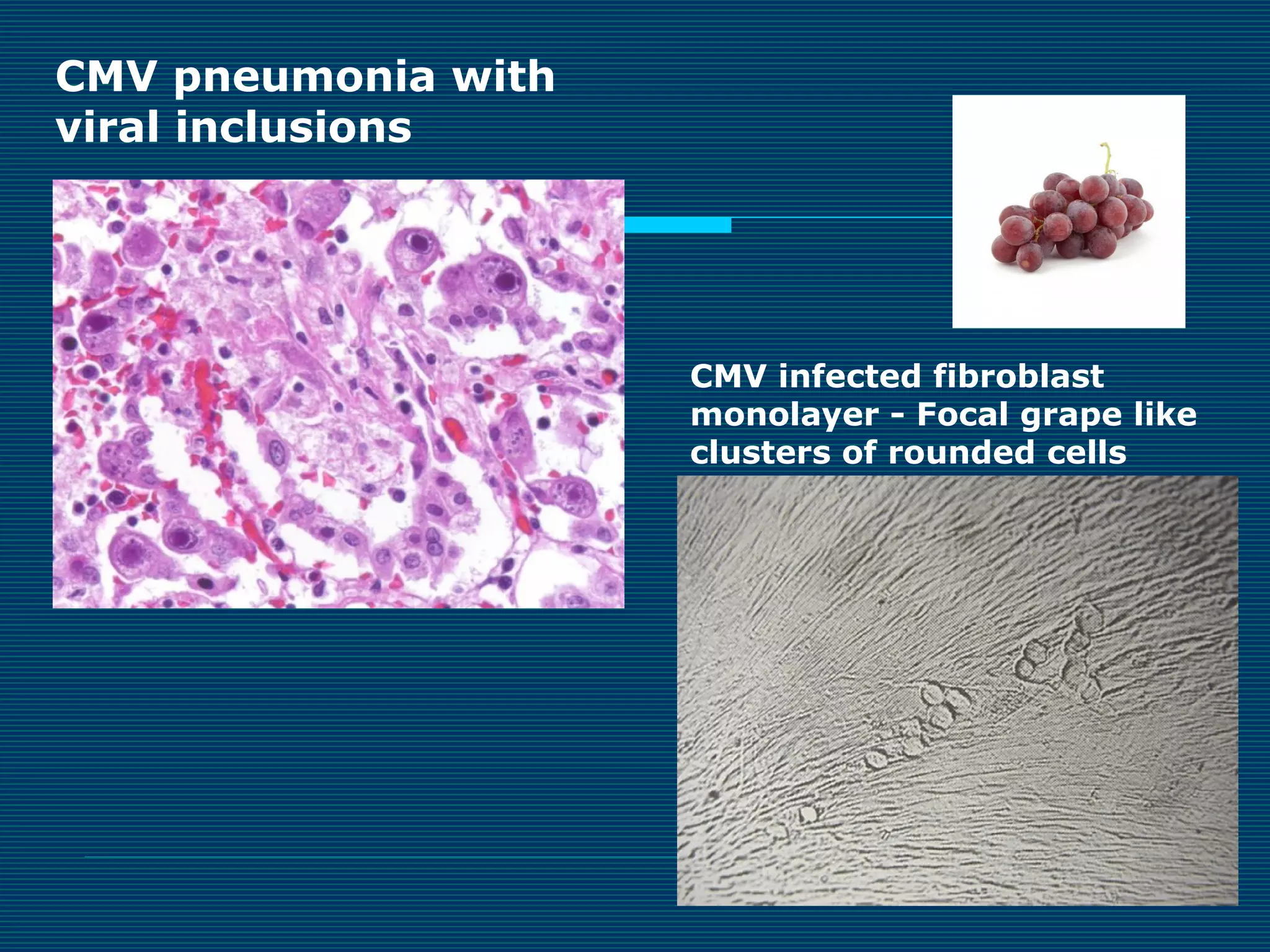 CMV pneumonia with
viral inclusions

CMV infected fibroblast
monolayer - Focal grape like
clusters of rounded cells

 