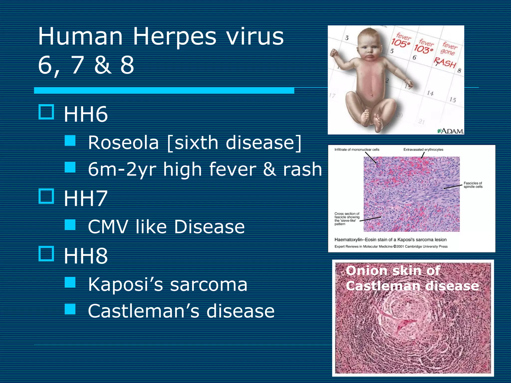 Human Herpes virus
6, 7 & 8
 HH6
 Roseola [sixth disease]
 6m-2yr high fever & rash

 HH7
 CMV like Disease

 HH8
 Kaposi’s sarcoma
 Castleman’s disease

Onion skin of
Castleman disease

 
