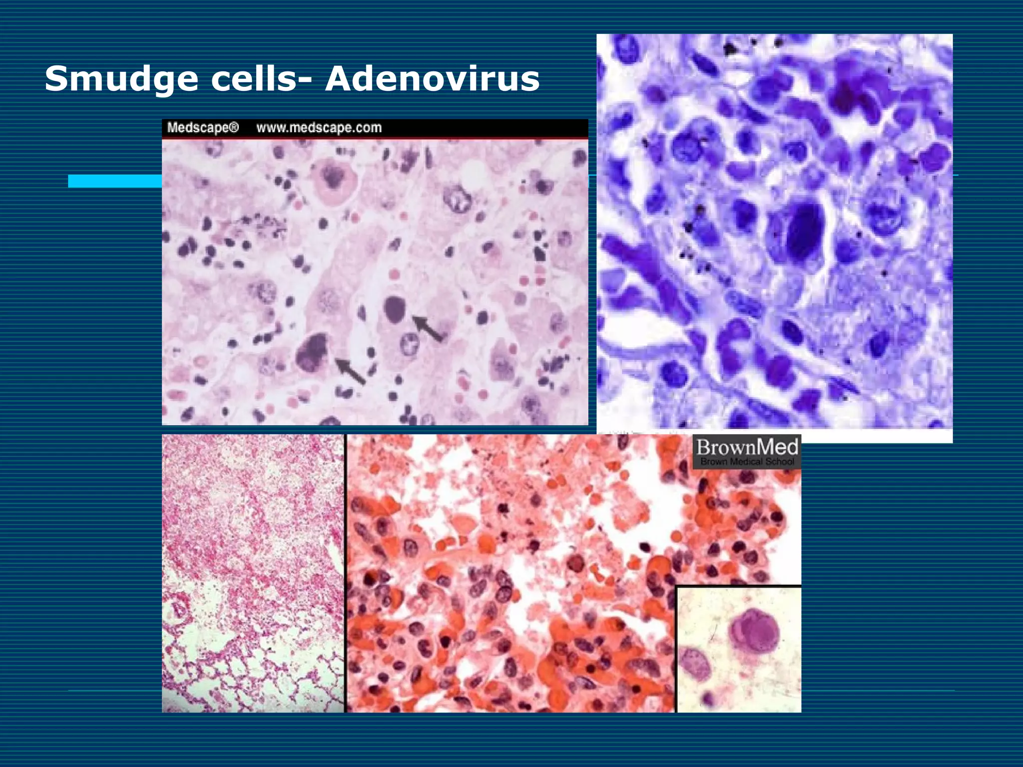 Smudge cells- Adenovirus

 