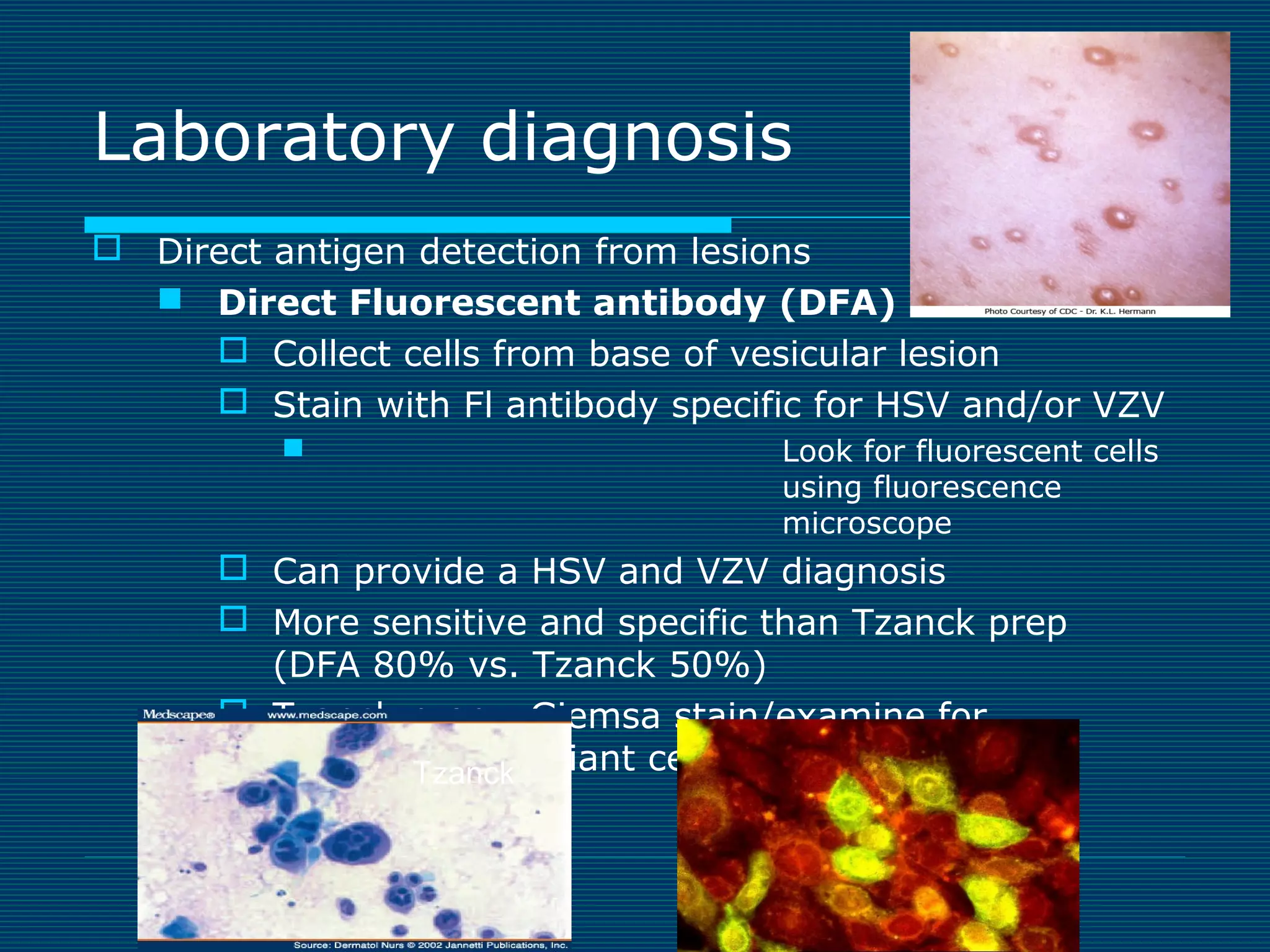 Laboratory diagnosis
 Direct antigen detection from lesions
 Direct Fluorescent antibody (DFA) stain
 Collect cells from base of vesicular lesion
 Stain with Fl antibody specific for HSV and/or VZV


Look for fluorescent cells
using fluorescence
microscope

 Can provide a HSV and VZV diagnosis
 More sensitive and specific than Tzanck prep
(DFA 80% vs. Tzanck 50%)
 Tzanck prep= Giemsa stain/examine for
multinucleated giant cells of Herpes virus
Tzanck

 