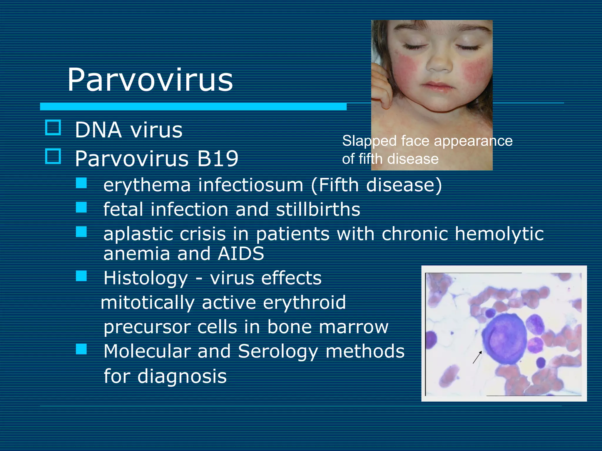 Parvovirus
 DNA virus
 Parvovirus B19

Slapped face appearance
of fifth disease

 erythema infectiosum (Fifth disease)
 fetal infection and stillbirths
 aplastic crisis in patients with chronic hemolytic
anemia and AIDS
 Histology - virus effects
mitotically active erythroid
precursor cells in bone marrow
 Molecular and Serology methods
for diagnosis

 