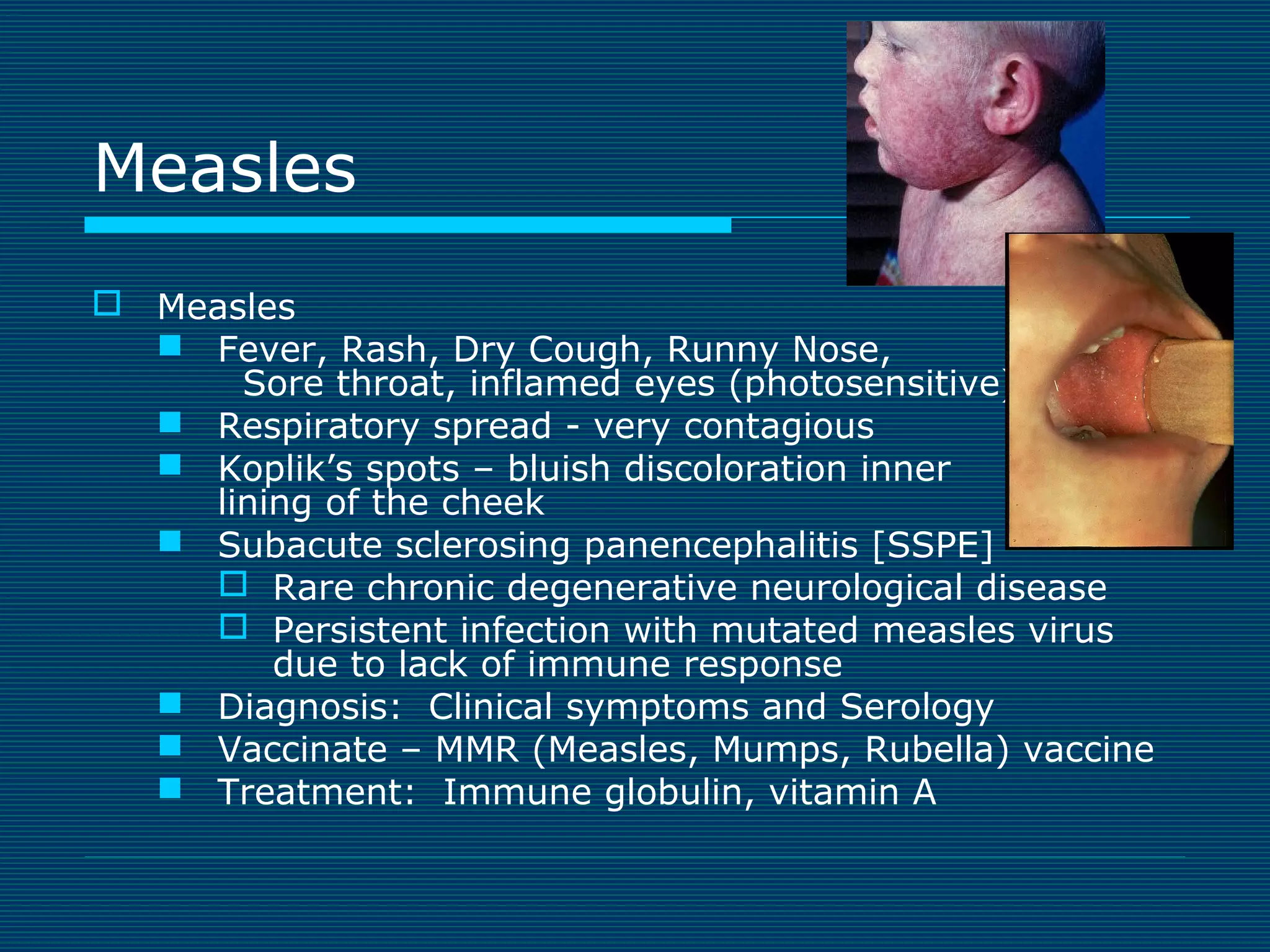 Measles
 Measles
 Fever, Rash, Dry Cough, Runny Nose,
Sore throat, inflamed eyes (photosensitive)
 Respiratory spread - very contagious
 Koplik’s spots – bluish discoloration inner
lining of the cheek
 Subacute sclerosing panencephalitis [SSPE]
 Rare chronic degenerative neurological disease
 Persistent infection with mutated measles virus
due to lack of immune response
 Diagnosis: Clinical symptoms and Serology
 Vaccinate – MMR (Measles, Mumps, Rubella) vaccine
 Treatment: Immune globulin, vitamin A

 