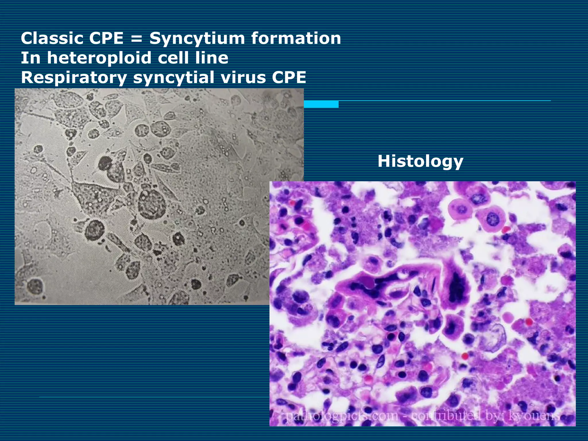Classic CPE = Syncytium formation
In heteroploid cell line
Respiratory syncytial virus CPE

Histology

 