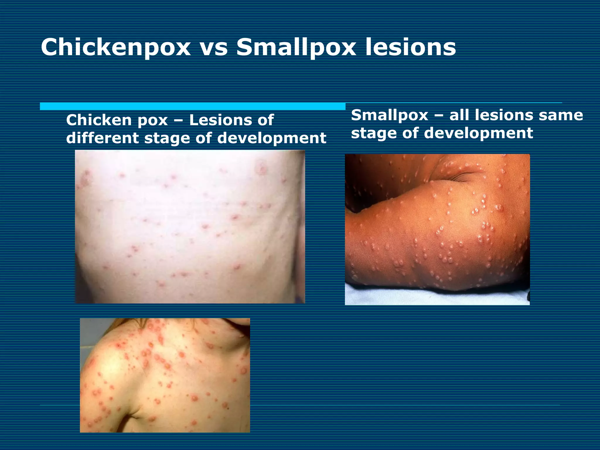 Chickenpox vs Smallpox lesions
Chicken pox – Lesions of
different stage of development

Smallpox – all lesions same
stage of development

 