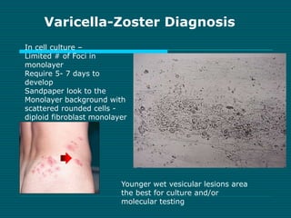Varicella-Zoster Diagnosis 
In cell culture – 
Limited # of Foci in 
monolayer 
Require 5- 7 days to 
develop 
Sandpaper l...