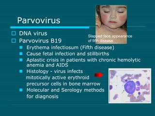 Parvovirus 
 DNA virus 
 Parvovirus B19 
 Erythema infectiosum (Fifth disease) 
 Cause fetal infection and stillbirths...