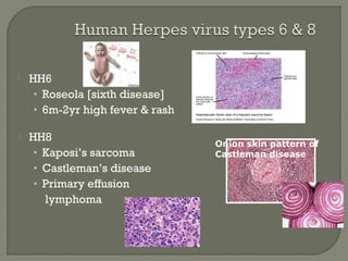  HH6
• Roseola [sixth disease]
• 6m-2yr high fever & rash
 HH8
• Kaposi’s sarcoma
• Castleman’s disease
• Primary effusion
lymphoma
Onion skin pattern of
Castleman disease
 