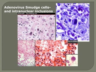 Adenovirus Smudge cells-
and intranuclear inclusions
 