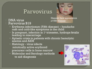  DNA virus
 Parvovirus B19
• Erythema infectiosum (Fifth disease) – headache
rash and cold-like symptoms in the child
• In pregnant, infection in 1st
trimester, hydrops fetalis
leading to miscarriage
• Aplastic crisis in patients with chronic hemolytic
anemia and AIDS
• Histology - virus infects
mitotically active erythroid
precursor cells in bone marrow
• Molecular and Serology methods
to aid diagnosis
Slapped face appearance
of fifth disease
 