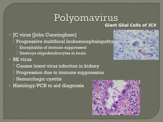 • JC virus [John Cunningham]
 Progressive multifocal leukoencephalopathy -
 Encephalitis of immune suppressed
 Destroys oligodendrocytes in brain
• BK virus
 Causes latent virus infection in kidney
 Progression due to immune suppression
 Hemorrhagic cystitis
• Histology/PCR to aid diagnosis
Giant Glial Cells of JCV
 
