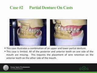 Case #2                      Partial Denture On Casts




 This case illustrates a combination of an upper and lower partial denture.
 This case is limited. All of the posterior and anterior teeth on one side of the
  mouth are missing. This requires the placement of wire retention on the
  anterior teeth on the other side of the mouth.


     Energy Square Prosthodontics
     www.energysquaredental.ca                                          5
 