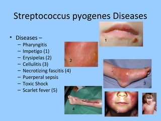 Streptococcus pyogenes Diseases
• Diseases –
– Pharyngitis
– Impetigo (1)
– Erysipelas (2)
– Cellulitis (3)
– Necrotizing fascitis (4)
– Puerperal sepsis
– Toxic Shock
– Scarlet fever (5)
1
2
3
4
5
 