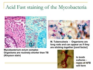 Acid Fast staining of the Mycobacteria
Mycobacterium avium complex
Organisms are routinely shorter than TB
(Kinyoun stain)...