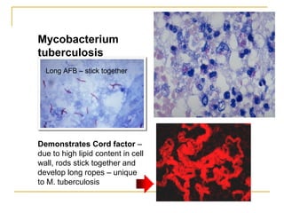 Mycobacterium
tuberculosis
Demonstrates Cord factor –
due to high lipid content in cell
wall, rods stick together and
deve...