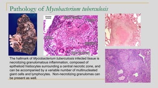 Pathology of Mycobacterium tuberculosis
The hallmark of Mycobacterium tuberculosis infected tissue is
necrotizing granulomatous inflammation, composed of
epithelioid histiocytes surrounding a central necrotic zone, and
can be accompanied by a variable number of multinucleated
giant cells and lymphocytes. Non-necrotizing granulomas can
be present as well.
 