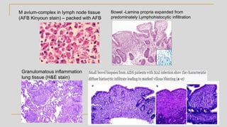 M avium-complex in lymph node tissue
(AFB Kinyoun stain) – packed with AFB
Granulomatous inflammation
lung tissue (H&E stain)
Bowel -Lamina propria expanded from
predominately Lymphohistocytic infiltration
 