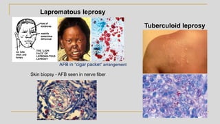 Tuberculoid leprosy
Lapromatous leprosy
Skin biopsy - AFB seen in nerve fiber
AFB in “cigar packet” arrangement
 