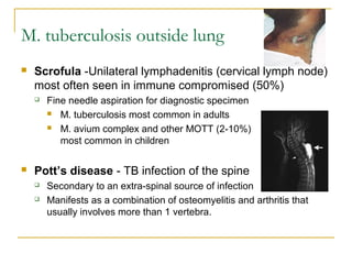 M. tuberculosis outside lung
 Scrofula -Unilateral lymphadenitis (cervical lymph node)
most often seen in immune compromised (50%)
 Fine needle aspiration for diagnostic specimen
 M. tuberculosis most common in adults
 M. avium complex and other MOTT (2-10%)
most common in children
 Pott’s disease - TB infection of the spine
 Secondary to an extra-spinal source of infection
 Manifests as a combination of osteomyelitis and arthritis that
usually involves more than 1 vertebra.
 