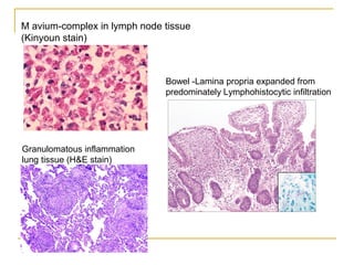 M avium-complex in lymph node tissue
(Kinyoun stain)
Granulomatous inflammation
lung tissue (H&E stain)
Bowel -Lamina propria expanded from
predominately Lymphohistocytic infiltration
 