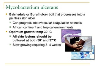 Mycobacterium ulcerans
 Bairnsdale or Buruli ulcer boil that progresses into a
painless skin ulcer
 Can progress into av...