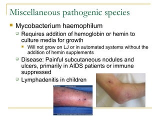 Miscellaneous pathogenic species
 Mycobacterium haemophilum
 Requires addition of hemoglobin or hemin to
culture media f...