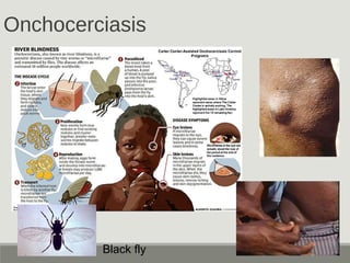 Onchocerciasis
Black fly
 