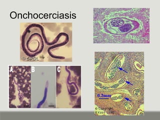 Onchocerciasis
 