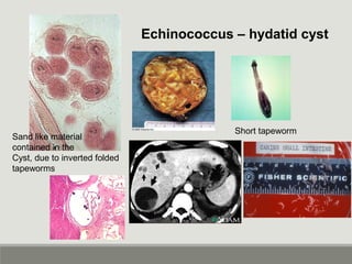 Echinococcus – hydatid cyst
Short tapeworm
Sand like material
contained in the
Cyst, due to inverted folded
tapeworms
 
