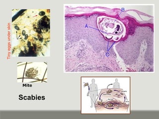 Scabies
Tinyeggsunderskin
Mite
 