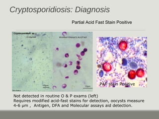 Cryptosporidiosis: Diagnosis
Partial Acid Fast Stain Positive
Not detected in routine O & P exams (left)
Requires modified acid-fast stains for detection, oocysts measure
4-6 µm , Antigen, DFA and Molecular assays aid detection.
PAF stain Positive
 