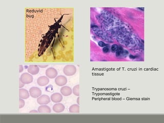 Trypanosoma cruzi –
Trypomastigote
Peripheral blood – Giemsa stain
Reduvid
bug
Amastigote of T. cruzi in cardiac
tissue
 
