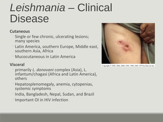 Leishmania – Clinical
Disease
Cutaneous
◦Single or few chronic, ulcerating lesions;
many species
◦Latin America, southern Europe, Middle east,
southern Asia, Africa
◦Mucocutaneous in Latin America
Visceral
◦primarily L. donovani complex (Asia), L.
infantum/chagasi (Africa and Latin America),
others
◦Hepatosplenomegaly, anemia, cytopenias,
systemic symptoms
◦India, Bangladesh, Nepal, Sudan, and Brazil
◦Important OI in HIV infection
 