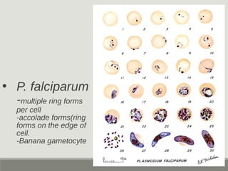 • P. falciparum
-multiple ring forms
per cell
-accolade forms(ring
forms on the edge of
cell.
-Banana gametocyte
 