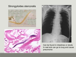 Strongyloides stercoralis
Can be found in intestines or stools
In real sick can go to lung and cause
pneumonia
 