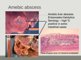 Amebic abscess
Flask-shaped ulcer of intestinal amebiasis
Amebic liver abscess
Entamoeba histolytica
Serology – high %
pos...