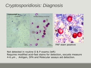 Cryptosporidiosis: Diagnosis
Not detected in routine O & P exams (left)
Requires modified acid-fast stains for detection, ...