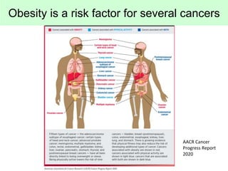 Obesity is a risk factor for several cancers
AACR Cancer
Progress Report
2020
 