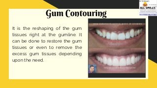Gum Contouring
It is the reshaping of the gum
tissues right at the gumline. It
can be done to restore the gum
tissues or even to remove the
excess gum tissues depending
upon the need.
 