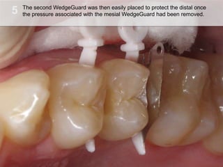 5,[object Object],The second WedgeGuard was then easily placed to protect the distal once the pressure associated with the mesialWedgeGuard had been removed.,[object Object]