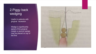 2.Piggy back
wedging
Useful in patients with
gingival recession
Wedge is significantly
apical of the gingival
margin a second wedge
may be placed on top of
the first
 