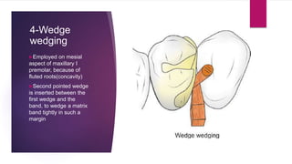 4-Wedge
wedging
Employed on mesial
aspect of maxillary I
premolar, because of
fluted roots(concavity)
Second pointed wedge
is inserted between the
first wedge and the
band, to wedge a matrix
band tightly in such a
margin
 