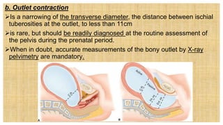 b. Outlet contraction
Is a narrowing of the transverse diameter, the distance between ischial
tuberosities at the outlet, to less than 11cm
is rare, but should be readily diagnosed at the routine assessment of
the pelvis during the prenatal period.
When in doubt, accurate measurements of the bony outlet by X-ray
pelvimetry are mandatory.
 
