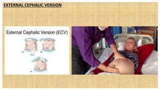 EXTERNAL CEPHALIC VERSION
 