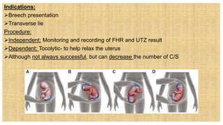 Indications:
Breech presentation
Transverse lie
Procedure:
Independent: Monitoring and recording of FHR and UTZ result
Dependent: Tocolytic- to help relax the uterus
Although not always successful, but can decrease the number of C/S
 