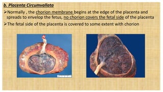 b. Placenta Circumvallata
Normally , the chorion membrane begins at the edge of the placenta and
spreads to envelop the fetus, no chorion covers the fetal side of the placenta
The fetal side of the placenta is covered to some extent with chorion
 