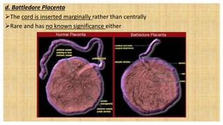 d. Battledore Placenta
The cord is inserted marginally rather than centrally
Rare and has no known significance either
 