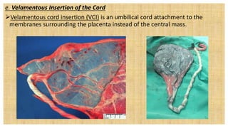 e. Velamentous Insertion of the Cord
Velamentous cord insertion (VCI) is an umbilical cord attachment to the
membranes surrounding the placenta instead of the central mass.
 