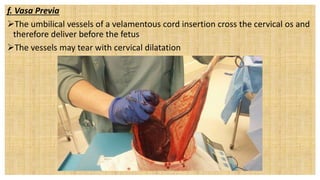 f. Vasa Previa
The umbilical vessels of a velamentous cord insertion cross the cervical os and
therefore deliver before the fetus
The vessels may tear with cervical dilatation
 