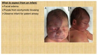What to expect from an Infant:
Facial edema
Purple from ecchymotic bruising
Observe infant for patent airway
 